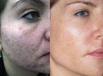 procell therapies near me