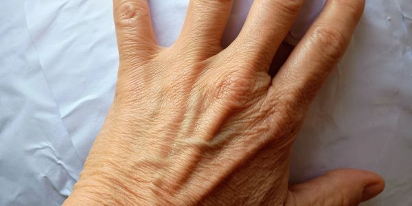 Close-up of an elderly hand showing wrinkles.