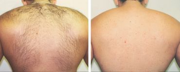 laser hair removal for men