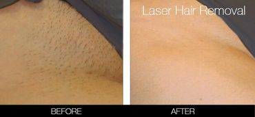 best laser hair removal in south Surrey