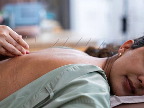 Acupuncture or dry needling help with a variety of issues as part of an integrated physiotherapy tre