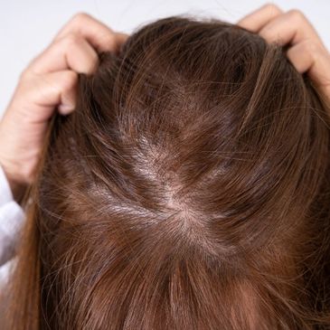 female scalp showing signs of hair loss