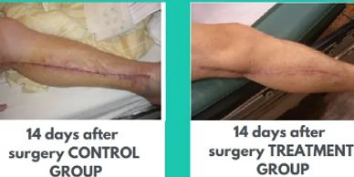 Comparison of leg scars 14 days after surgery between control and treatment groups.