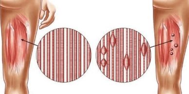 Illustration comparing healthy and torn thigh muscles.