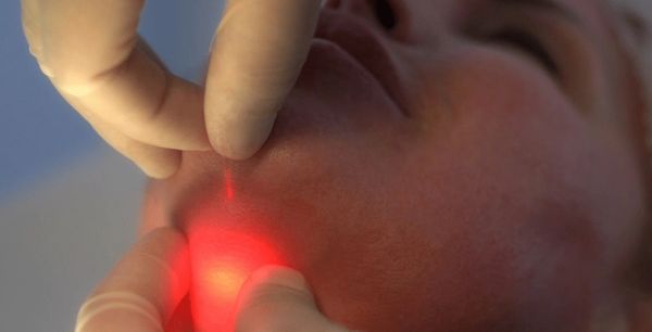 Endolift laser for neck