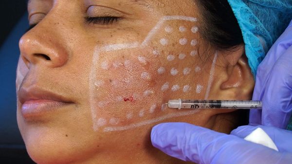botox for skin quality microtox