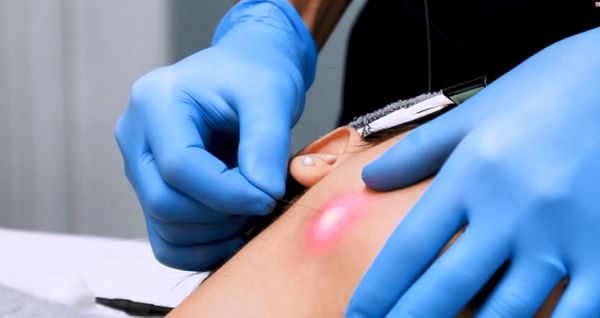 laser lift for the face