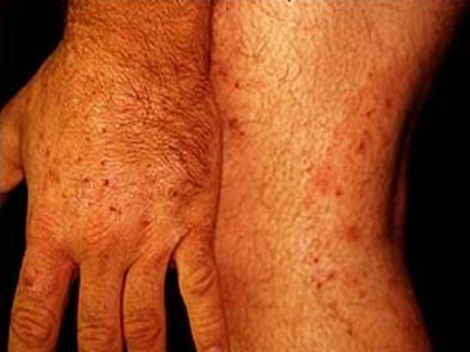 Mold Skin Infections.JPG