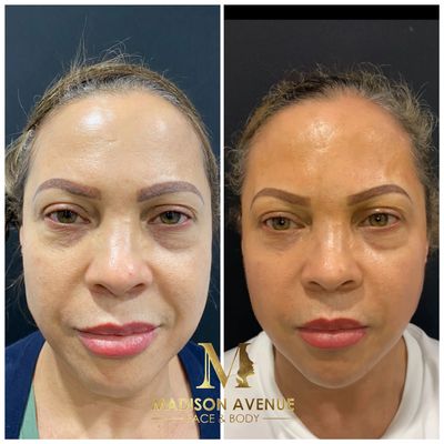 Secret RF microneedling Results Latina woman Madison Avenue Face and Body
