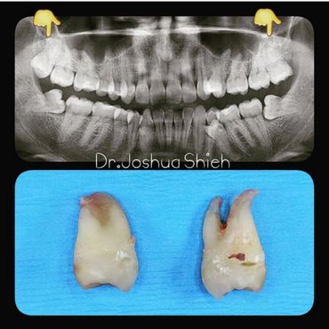 Wisdom Teeth Extraction