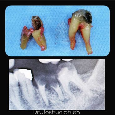 Removal of Badly Broken Teeth