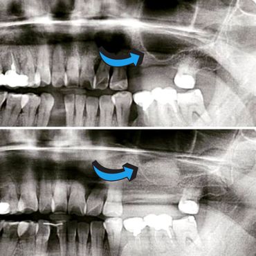 Bone Graft Prior to Dental Implant