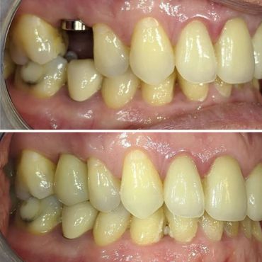 Single Tooth Implant with Bone Graft.