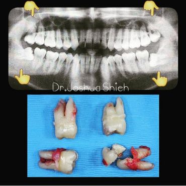Four Wisdom Teeth Removal