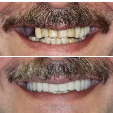 Full Arch Dental Implants - Natural Smile, better eating, better speech. Younger Look!