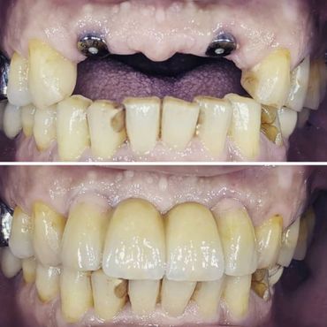 Implant Supported Bridge - Replacing Four Missing Teeth with 2 Implants Only! No more Dentures!