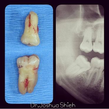 Wisdom teeth Removal
