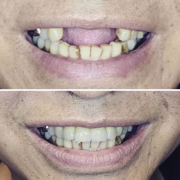 Implant Supported Bridge - Replacing Four Missing Teeth with Two Implants