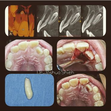 Removal of Impacted Tooth