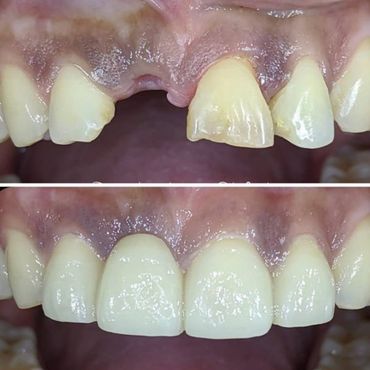 Dental Implant at North Star Dentistry in Mississauga.
