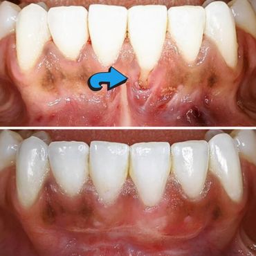 Single Tooth Gum Graft and Frenectomy