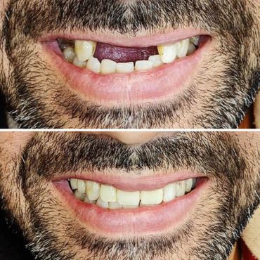 Implant Supported Bridges - Natural Results, better eating and speech. Younger look and bright smile