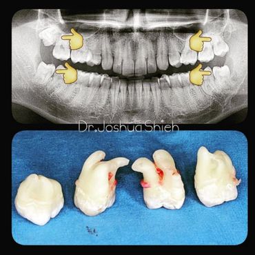 Four Wisdom Teeth Removal
