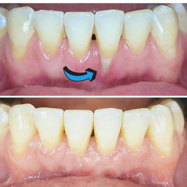Single Tooth Gum Graft