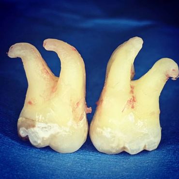 Wisdom Teeth Extraction