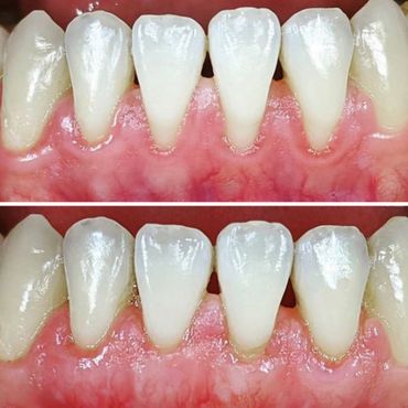 Gum Grafts - Treatment of Receding Gums