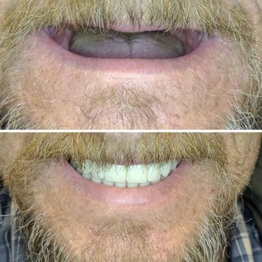 Full Mouth Reconstruction with dental implants.