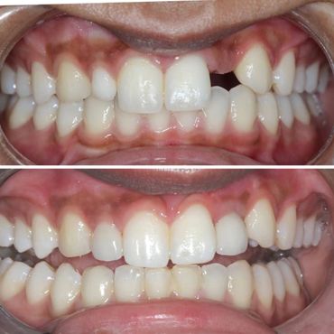 Single Tooth Implant
