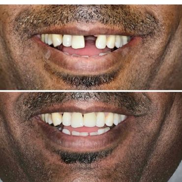 Single Tooth Implant - Natural Results, High Success Rate!