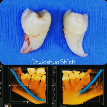 Wisdom Teeth Removal - Guided by CT scan