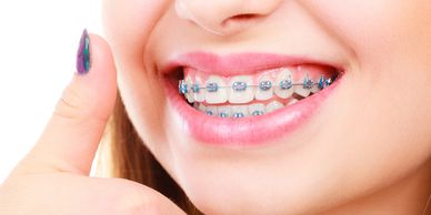 braces, ortho braces, invisalign, clear aligners, clearcorret, smile direct club, crooked teeth