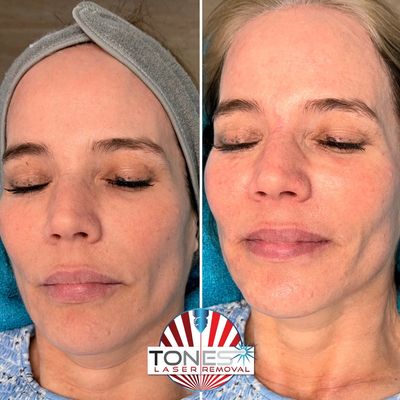 Carbon facial treatment, Hythe Southampton glowing skin