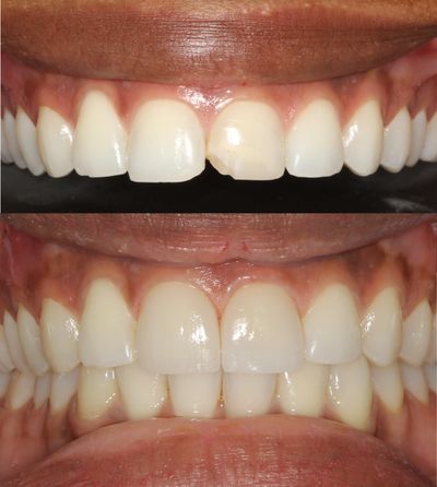 Transform smiles with porcelain veneers