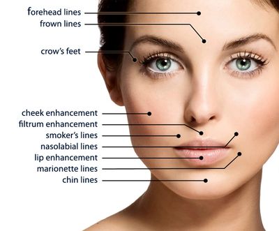 Areas addressed with Botox and Fillers.