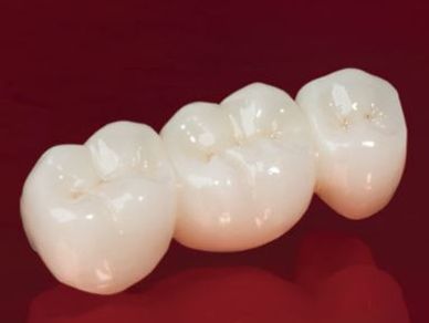 image of a porcelain zirconia dental bridge