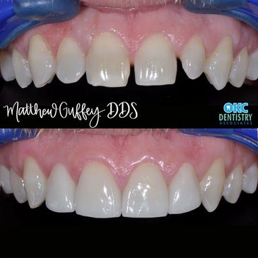 Cosmetic Dentistry Veneers Composite Bonding
