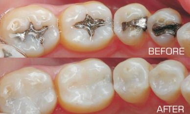 Image of tooth colored filling versus silver amalgam filling