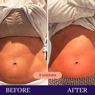 Cryo slimming Facial near me