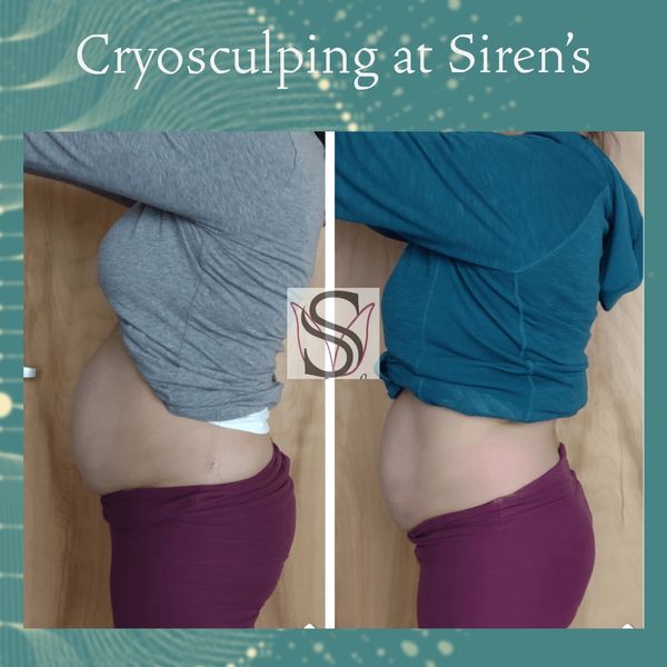 cryotherapy for weight loss
