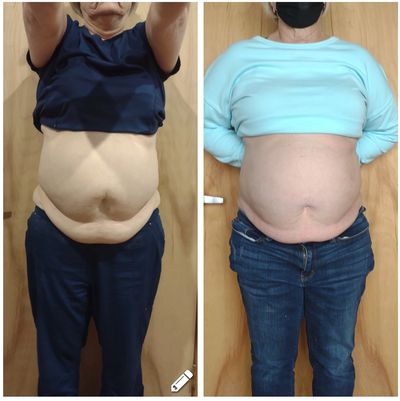 non surgical tummy tuck
