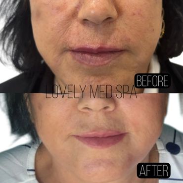 2 weeks after 1st treatment