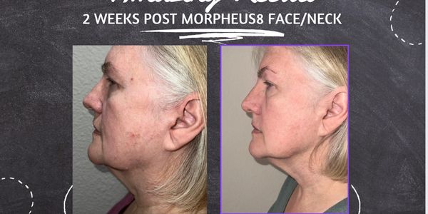MORPHEUS8  FACE AND NECK< AFTER JUST ONE TREATMENT