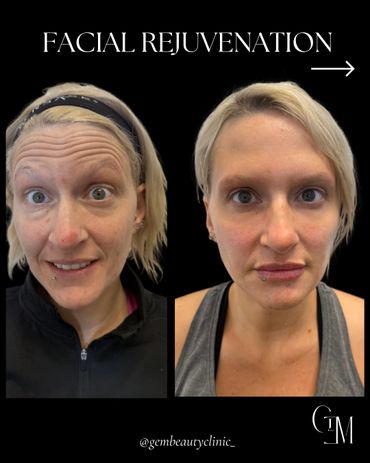 facial rejuvenation