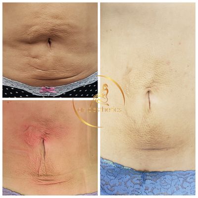 ari aesthetics, post op, post op lymphatic drainage, detox lymphatic drainage, facial in Watchung