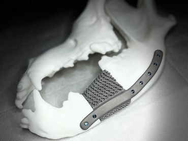 Custom designed 3D printed titanium implant