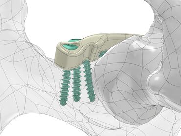 Custom PEEK hip implant for hip dysplasia